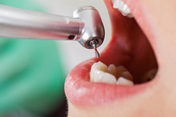 Best Emergency Root Canal Treatment in Homer, IL